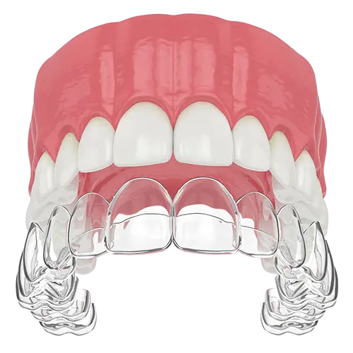 Hareketli Pekiştirme Apareyleri - Clear Retainer Hareketli Pekiştirme Apareyleri - Clear Retainer