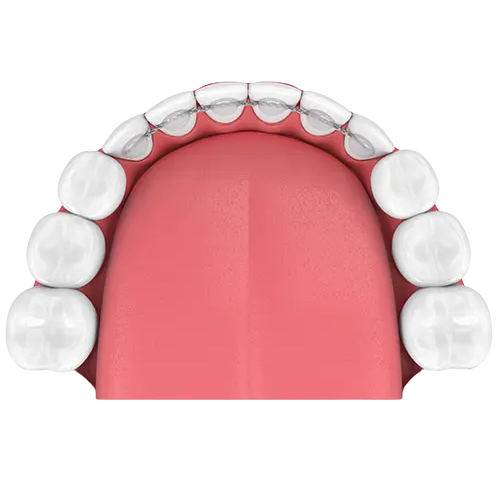 Sabit Pekiştirme Apareyleri - Fixed Retainer Sabit Pekiştirme Apareyleri - Fixed Retainer