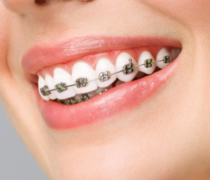 Metal Braketler (Geleneksel)