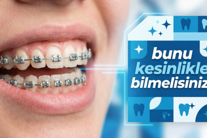 Diş Teli Kullanıyorsan Bunları Kesinlikle Bilmelisin