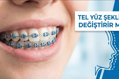 Diş Teli Yüz Şeklini Değiştirir mi? Ortodonti ve Yüz Estetiği