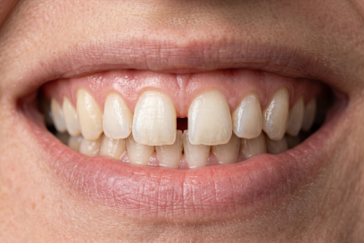 Dişler Arasında Boşluk (Diastema) Neden Oluşur? Ortodontik Tedavi Şart mı?