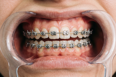 Diş Teli Tedavisi Yarım Bırakılırsa Ne Olur?