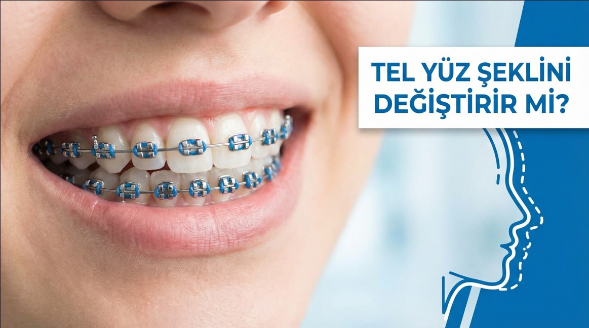 Diş Teli Yüz Şeklini Değiştirir mi? Ortodonti ve Yüz Estetiği